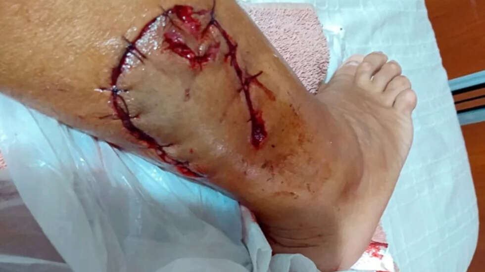 Brutal ataque de un perro a una mujer en Santa Rosa