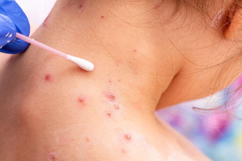 Viruela del mono: la Organización Mundial de la Salud emite pedido para contenerla