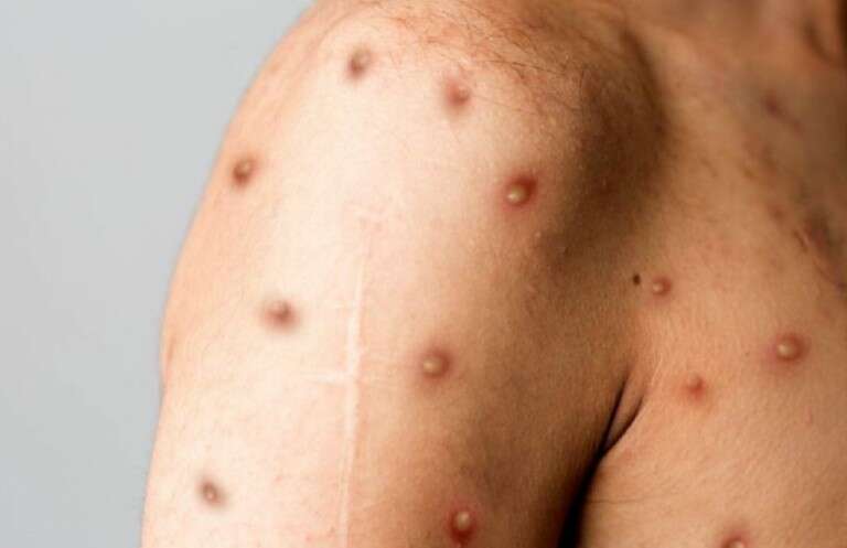 Viruela del mono: confirmaron tres nuevos casos en el país