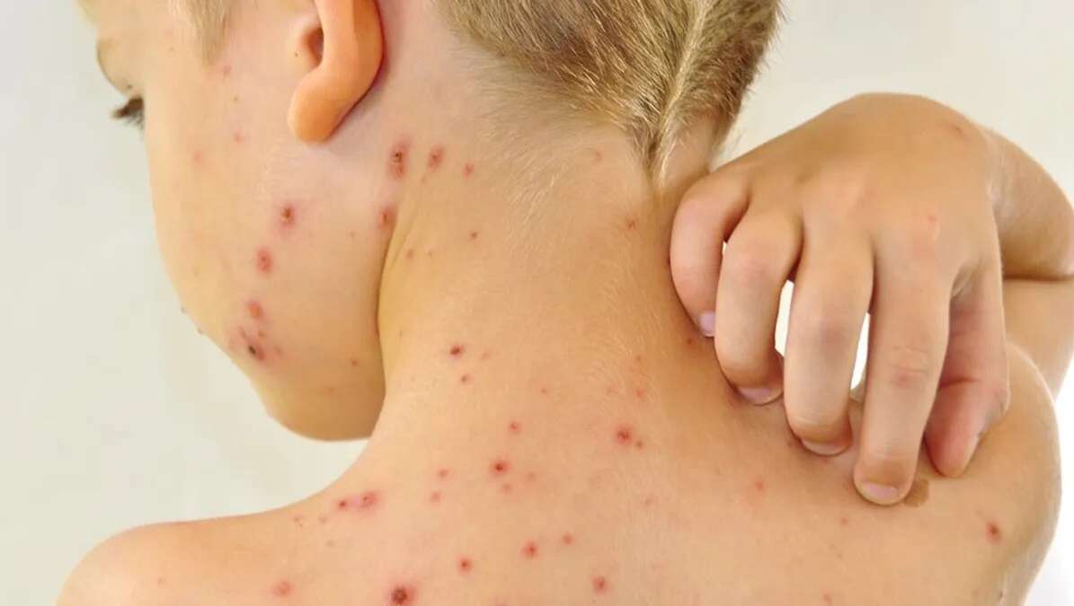 Salud Pública informó sobre el streptococcus pyogenes que ya provocó 76 fallecimientos en el país