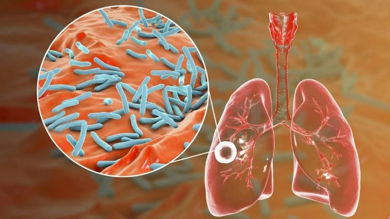 “Alerta tuberculosis”, se notificaron más de 13.000 casos en Argentina